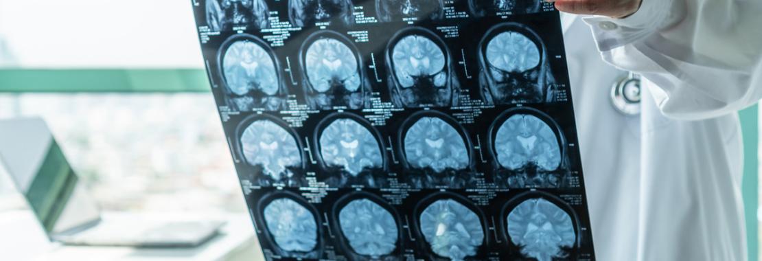 Glioblastoma, creato una “Gps” molecolare per guidare le cellule immunitarie nel tumore del cervello