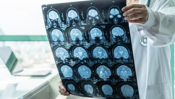 Glioblastoma, creato una “Gps” molecolare per guidare le cellule immunitarie nel tumore del cervello